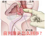 急性前列腺炎